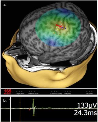 Biomarkers Obtained by Transcranial Magnetic Stimulation of the Motor Cortex in Epilepsy